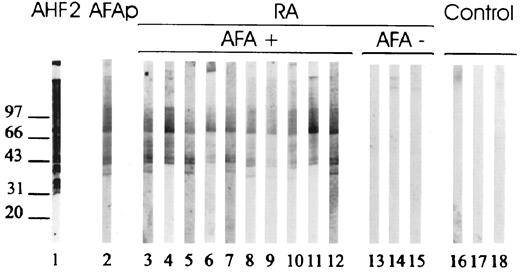 FIGURE 4. Recognition of deiminated human recombinant filaggrin by human sera is related to their AFA activity. Human recombinant GST-filaggrin was incubated for 1 h at 50°C with 7.5 U/mg protein of PAD, separated by SDS-PAGE, and analyzed by immunoblotting with AHF2 (lane 1), a pool of AFA affinity-purified from 45 RA sera (lane 2, AFAp), RA sera with high titers of AFA (lanes 3–12), AFA-negative RA sera (lanes 13–15), or control sera (lanes 16–18).