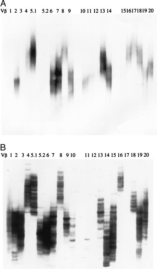 FIGURE 1. SSCP profiles of unseparated PBMC. Unseparated PBMC from healthy subjects (HS) and MS patients were examined by SSCP clonotype analysis. Shown are representative SSCP profiles. Each lane shows an electrophoretic pattern of denatured DNA amplified by a set of a Vβ and the Cβ primers (from left to right: Vβ1–5.1, 5.2, and 6–20). A, SSCP profile of an HS showing a smear pattern. B, SSCP profile of an MS in relapse demarcating multiple distinctive bands.