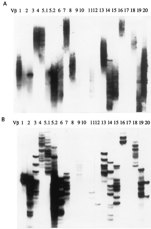 FIGURE 3. SSCP-based comparison of CD3+CD25+ population with unseparated PBMC. The unseparated PBMC of an HS (upper panel) was compared with the CD3+CD25+ sorted from the same PBMC (lower panel) by SSCP clonotype analysis.