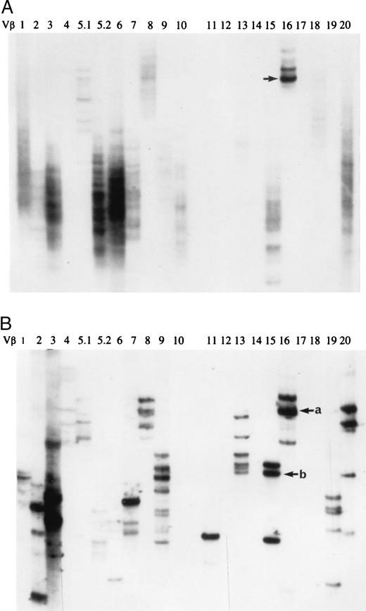 FIGURE 5. SSCP profiles of CD3+CD25+ population from patient OK with relapsing/remitting MS. A, June 1996. The sample was obtained during a remission phase. The PLP95–116-specific 2BA205 clonotype is indicated by an arrow. B, November 1996. The patient was in relapse at the sampling. Arrow a indicates the “persistent” 2BA205 clonotype, and b indicates a clonotype of TCCL 118.23.