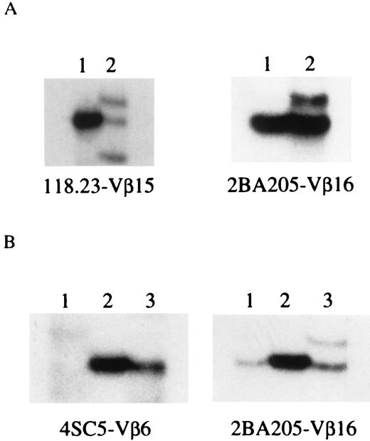 FIGURE 6. Direct comparison of TCCL and in vivo expanded clones. Samples obtained at the same time were directly compared by SSCP analysis. TCCL code and the Vβ gene of examined clonotype are shown below each. A, Comparison between TCCL and CD25+ T cells. Lane 1, TCCL; lane 2, CD25+ T cells sorted from PBMC. B, Comparison of TCCL, CD25+ T cells, and CSF. Lane 1, CSF; lane 2, TCCL; lane 3, CD25+ T cells sorted from PBMC.