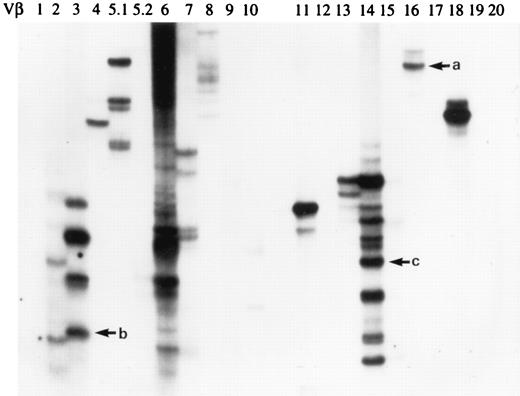 FIGURE 8. Analysis of CSF T cells. After PCR amplification for 38 cycles, the cDNAs derived from CSF were processed and displayed on the SSCP gel. The result of the November 1996 sample from patient OK is shown. Arrow a corresponds to 2BA205, and b and c to clonotypes from TCCL118.19.