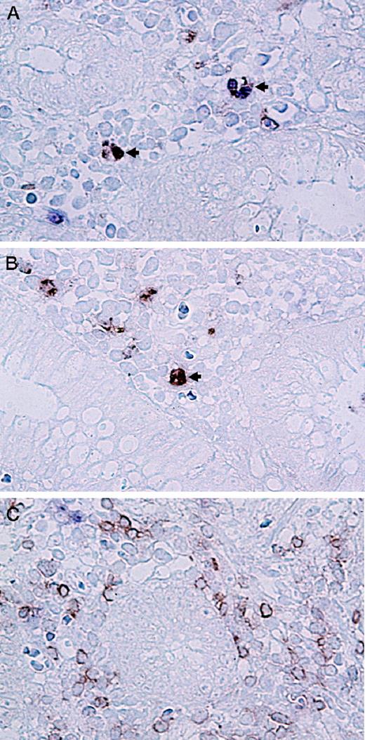 FIGURE 1. Double immunohistochemical staining identifying the phenotype of apoptotic leukocytes in the intestinal lamina propria. A, Arrows indicate two TUNEL+ and MPO-7+ polymorphonuclear neutrophils. B, Arrow indicates a TUNEL+ and CD68+ macrophage. C, Abundant CD45RO+, TUNEL− leukocytes. Micrographs taken from the same tissue section of a representative ulcerative colitis specimen (original magnification, ×400).