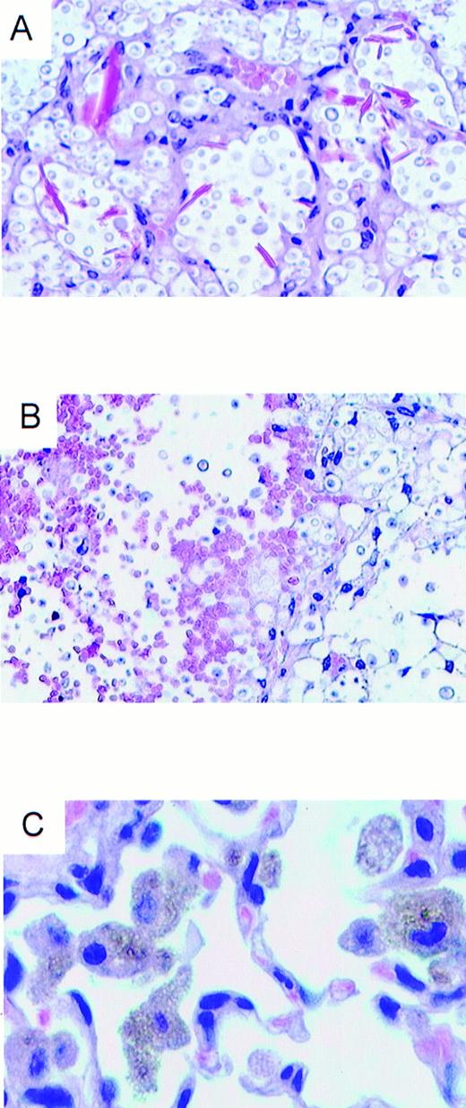 FIGURE 5. Lung pathology in MIP-1α−/− mice infected with C. neoformans at week 10 postinfection (magnification, ×330; hematoxylin and eosin). A, Eosinophilic crystals and cryptococci in MIP-1α−/− mice. Note the alveolar destruction in the areas of crystal deposition and uncontrolled growth of cryptococci. B, Pulmonary hemorrhage in a lung of MIP-1α−/− mice. Note the extravascular RBC in the alveolar spaces. C, Hemosiderophages in the alveolar spaces of MIP-1α−/− mice. Note the macrophages that had phagocytized and degraded RBC (hemosiderophages with extended cytoplasm containing phagocytized RBC ghosts and characteristic olive-brown coloration of hemosiderin). The presence of hemosiderophages provides evidence of intravital pulmonary bleeding in MIP-1α−/− mice.