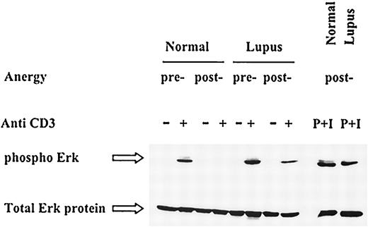 FIGURE 6. Ability to phosphorylate ERK is preserved in lupus T cells upon second anti-CD3 stimulation after exposure to anergy protocol. Before (pre-) or after (post-) anergy induction, normal and lupus T cell lines were left untreated (−) or stimulated by anti-CD3 (+) for 10 min, or by PMA and ionomycin (P+I) for 2 min. Western immunoblot with anti-phospho-ERK and reprobing with anti-ERK mAb for total ERK protein were performed. This is a representative of four experiments.