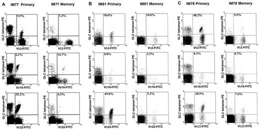FIGURE 4. FACS analysis of PBMC from IM77 (A), IM81 (B), and IM78 (C) taken either during the acute phase of the disease (primary) or 12–18 mo later (memory) and triple stained with Tricolor-labeled anti-CD8 mAb, PE-labeled A2.01/GLC tetramer, and individual mAbs specific for Vβ2, Vβ16, or Vβ22; the Vβ-specific reagents were either directly FITC-conjugated or detected indirectly with an FITC-labeled goat anti-mouse IgG1 (see Materials and Methods). All profiles show tetramer staining vs staining for the relevant Vβ marker and the percent value shown indicates the percent tetramer-positive cells that were positive for the Vβ marker. Note the diagonal profile of tetramer-positive/Vβ-positive double-stained populations, as would be expected using two reagents specific for the same molecular complex. The reduced tetramer levels seen on the double-stained tetramer-positive/Vβ2-positive cells in IM77 primary PBMC (A) may reflect competition between the two reagents; such an effect was not observed in other cases using the Vβ2-specific mAb and was never observed using other Vβ-specific mAbs (even when used unconjugated followed by an FITC-labeled anti-mouse Ig second step; data not shown). The percentage of CD8+ T cells that were tetramer positive at each time of sampling was as follows: IM77 primary 6.2%, memory 1.0%; IM81 primary 6.1%, memory 0.8%; and IM78 primary 4.3%, memory 0.8%.