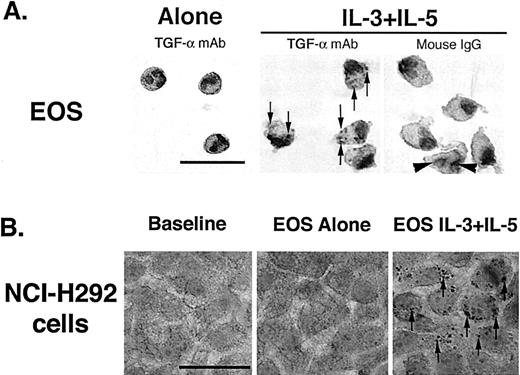 FIGURE 6. Immunohistochemical staining for TGF-α in eosinophils and NCI-H292 (epithelial) cells. A, Isolated human eosinophils. Human eosinophils (EOS) were isolated from peripheral blood, cultured for 16 h in RPMI alone (left panel) or with IL-3 plus IL-5 (middle and right panels), and then harvested and fixed. Cytospin smears were obtained and stained with an Ab to TGF-α or to mouse IgG (negative control) and counterstained with hematoxylin as described in Materials and Methods. Arrows, Granular staining for TGF-α. Note the change in shape of eosinophils incubated with IL-3 plus IL-5. Arrowheads, Bilobed nuclei of eosinophils. Photomicrographs are representative of three separate experiments (three EOS donors). Original magnification, ×1000. Bar, 20 μm. B, NCI-H292 cells. NCI-H292 cells were treated for 24 h with supernatant of eosinophils cultured alone or eosinophils cultured with IL-3 plus IL-5. After fixation, NCI-H292 cells alone (baseline, left panel) or NCI-H292 cells treated with supernatant of eosinophils cultured alone (EOS alone, middle panel) or with supernatant of activated eosinophils (EOS IL-3 plus IL-5, right panel), were stained with an Ab to TGF-α. Photomicrographs are representative of three separate experiments; arrows, granular staining for TGF-α. Original magnification, ×1000. Bar, 20 μm.