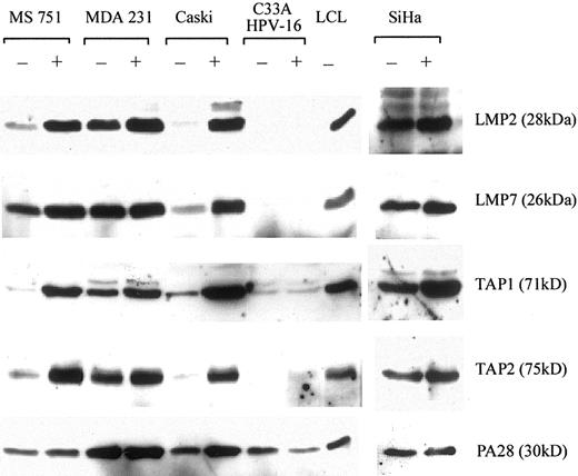 FIGURE 5. Cervical carcinoma cell lines express low levels of immunoproteasomes and TAP proteins that are up-regulated by IFN-γ. Carcinoma cell lines cultured with (+) or without (−) 200 U/ml of IFN-γ for 48 h were analyzed for expression of the immunoproteasome proteins LMP2 (28 kDa) and LMP7 (26 kDa), the transporter proteins TAP1 (71 kDa) and TAP2 (75 kDa), and the proteasomal regulator PA28 (30 kDa). The MUTU III B-LCL is included as a control.