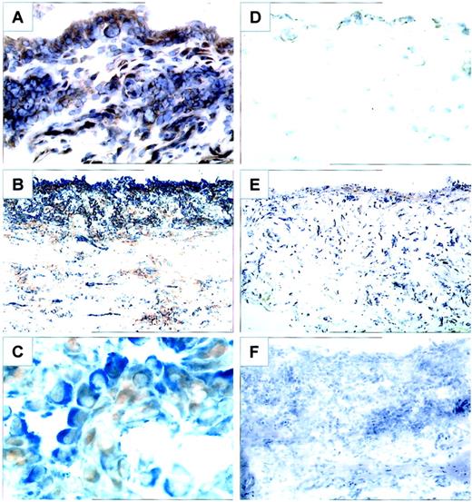 FIGURE 6. Immunohistochemical analysis of A2/RA33 expression in synovial tissue. Cryosections from a patient with RA (A–C and F) and a patient with OA (D and E) were stained with a mAb against A2/RA33 (A–E) or an isotype-matched control mAb (F). Cells were counterstained with either hematoxylin (A, D, and F) or an anti-CD68 mAb (B, C, and E) to identify synovial macrophages. Cells expressing A2/RA33 are stained brown; CD68-bearing cells are blue. Pronounced expression of A2/RA33 is visible in the lining layer and in the sublining areas of RA tissue (A–C), whereas in OA tissue many fewer cells are stained (D and E). Note both nuclear and cytoplasmic localization of A2/RA33 in RA synovial cells. Magnification: 100-fold (B, E, and F), 200-fold (A and D), and 400-fold (E).
