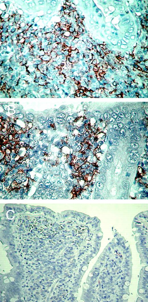 FIGURE 5. Infiltration of M-DC8+ cells in the subepithelial region of the ileum in patients with Crohn’s disease. A and B, Paraffin sections from ileal biopsies from two patients with initial onset of Crohn’s disease were stained with the M-DC8 Ab (magnification, ×800). C, M-DC8 staining of an ileal biopsy taken 6 mo after corticosteroid treatment (magnification, ×300).