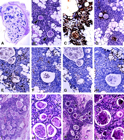 FIGURE 2. Thymus from X-SCID and nonimmunodeficient patients treated with corticosteroids in vivo. H&E-stained sections from a patient with X-SCID and lack of thymopoiesis (patient 1) show severe thymic hypoplasia/dysplasia (A) with normal-appearing Hassall bodies (B). These Hassall bodies react normally with pan-CK mAbs AE1/AE3 (C) and anti-involucrin mAb (D). CD3+ T cells (E) and CD20+ B cells (F) are markedly decreased in this thymus. Lack of thymopoiesis is confirmed by absence of CD1a+ (G) and Ki-67 (mib-1)+ (H) immature cortical thymocytes. H&E sections from the thymus of corticosteroid-treated patients without primary immunodeficiency show severe lymphocyte depletion and markedly increased numbers of Hassall bodies (patient 2 (I and J) and patient 3 (K and L)). The original magnifications were ×4 (A), ×66 (B–H), ×40 (I and K), and ×132 (J and L).