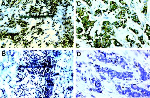 FIGURE 1. Expression of EGF-RvIII by primary breast carcinoma tissues. Sections of frozen breast carcinoma tissue derived from patient KJ (A and B) and fixed tissue derived from patient EJ (C and D) were incubated with murine mAb L8A4 (A and C) or control normal mouse IgG (B and D), followed by incubation with biotinylated goat anti-mouse IgG, avidin-peroxidase complex and substrate. Sections were counterstained with hematoxylin. Magnification: A and B, ×100; C and D, ×200.