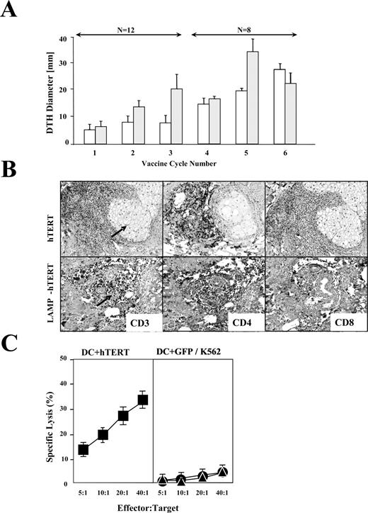 FIGURE 1. Analysis of cutaneous T cell infiltrates. A, Study patients were immunized with weekly doses of hTERT- (□) or LAMP hTERT (▦) mRNA-transfected DC. The diameter of induration was measured 48 h after every injection, each time by the same investigator. Erythema or induration >4 mm was considered significant. B, Skin biopsies were obtained 48 h following the third vaccination, and immunohistochemistry was performed to characterize T cell infiltrates. T cell infiltrates predominantly consisted of CD4+ and, to a lesser extent, CD8+ T cells that were preferentially clustered in close proximity to hair follicle cells (arrows). C, To determine Ag specificity of the infiltrating T cells, skin biopsies were obtained 48 h following the third vaccination and cultured in complete medium supplemented with IL-2 (50 U/ml) and 10 μg/ml PHA-P. Irradiated, allogeneic PBMC were used as feeder cells. After 2 wk of culture, T cells were tested for Ag specificity in standard 51Cr cytolytic assay at the indicated E:T ratios. hTERT mRNA-loaded DC were used as targets (▪). As controls, GFP mRNA-loaded DC (•) and K562 cells (▵) were used to control for unspecific-, or NK cell-mediated killing.