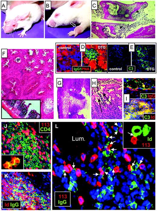 FIGURE 2. Pathology in doubly transgenic (DTG) mice. A, Typical skin disease in a doubly transgenic mouse. B, Arthritis in carpal joint (arrow) of a doubly transgenic mouse. C, Section of carpal joint (H&E stain). Pannus (∗) and extensive bone erosion (arrow) are depicted. D and E, Deposition of IgG1 (D) and C3 (E) in kidney sections of doubly transgenic but not control wild-type mice. Nuclei are shown in blue. PNA-rhodamine (red) counterstains tubuli cells in D. F–H, H&E stains of doubly transgenic colons. F, Low-power magnification of 40-day-old (inset) and 135-day-old doubly transgenic colons. Main panel and inset are shown with same magnification. G, Large ulcerating process with exudation of mononuclear cells (between ∗). The colon architecture is grossly abnormal. H, Bleeding of mononuclear cells from eroded lymphoid follicle (arrows). I, IgG (red) and C3 (green) deposits above lymphoid follicle (top). C3/IgG linear costain results in yellow (arrow). Cell nuclei are blue (DAPI). The colon lumen (top half of micrograph) contains stained material that probably represents sloughed cellular debris. Id+ Ig and C3 deposits that surround colon crypts and lymphoid aggregates (bottom). C3 (green) vs Id+ Ig red (2B6 mAb). J, Colon sections showing aggregates of T cells. CD4 (green) vs Id-specific TCR (GB113 clonotype specific mAb) (red). Cell nuclei are blue (DAPI). Numerous CD4+ non-Id-specific cells that express endogenous α- and β-chains (green only) are seen, whereas Id-specific CD4+ T cells (yellow) are fewer. Cluster of CD4+ Id-specific T cell blasts (inset). K, Colon of a doubly transgenic mouse (135-days-old) with IBD, stained for Id+ Ig (2B6 mAb) and IgG. Frequent Id+IgG+ B cells (yellow) are seen. L, Section of doubly transgenic colon with ulcerated crypt. IgG+ B cell blasts (green) and Id-specific T cell blasts (GB113, red) are shown in the main area. Lum, Lumen of crypt. Note the multiple contacts between IgG+ B cells and Id-specific T cells in the lamina propria (arrows). An ≈×1.3 greater magnification is shown (inset) than is shown in the main area. Id+ B cell blast (2B6) in synapse with Id-specific T cell blast (GB113) (red) in lamina propria.