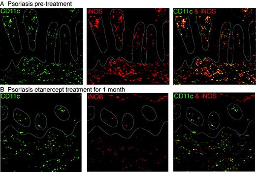 FIGURE 5. Reduction in iNOS protein expression in CD11c+ cells after 1 mo of etanercept treatment. A, Psoriasis lesional skin showing numerous epidermal and dermal CD11c, iNOS double-positive cells (yellow cells in right panel). B, Substantial reduction with etanercept treatment for 1 mo.