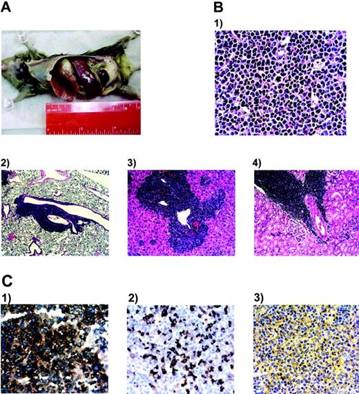 FIGURE 6. Development of lymphoma in Helios transgenic mice. Gross and microscopic examination of Helios transgenic mice >1 year of age demonstrated an aggressive lymphoproliferative disorder with multiorgan involvement. A, Exposed abdominal cavity demonstrating massively enlarged spleen and marked mesenteric lymphadenopathy. B, H&E stained sections of lymph node (panel 1, magnification ×400), lungs (panel 2, magnification ×40), liver (panel 3, magnification ×100), and kidney (panel 4, magnification ×100) demonstrate an aggressive lymphoproliferative disorder. The lymph node architecture is completely effaced by monomorphic, CD45R+/CD3− lymphoid cells. Mitotic activity is brisk and apoptotic cells are abundant, indicating a rapidly proliferating lesion. Neoplastic B cells surround larger lung airways and vascular channels (panel 2), form mainly periportal and central venous aggregates in the liver (panel 3), and form interstitial space clusters near glomeruli and proximal tubules in the kidney (panel 4). C, Immunohistochemistry of a representative tumor mass is shown. Tumor mass was stained with CD45R (panel 1), CD5 (panel 2), and CD43 (panel 3) Abs. The results reveal that tumor cells are CD45R+, CD5+, and CD43−.
