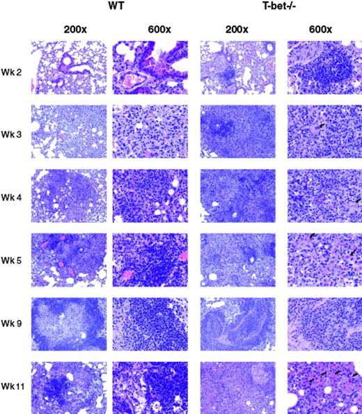 FIGURE 2. Lung lesions of T-bet−/− and WT mice after aerosol infection with M. tuberculosis. T-bet−/− and WT mice were infected with a low dose of M. tuberculosis. At 2, 3, 4, 5, 9, and 11 wk postinfection, lung tissues were fixed in 10% neutral buffered Formalin and embedded in paraffin, and 6-μm sections were stained with H&E. The microscopic images were taken at ×200 and ×600 magnification. T-bet−/− mice had more prominent lymphocytic infiltrates than WT mice at 2 wk postinfection, before any differences in bacterial numbers. The first multinucleated giant cells were observed in the lungs of T-bet−/− mice at 3 wk postinfection (filled arrows). At 4–11 wk postinfection, when bacterial numbers were significantly higher in T-bet−/− mice, neutrophils, multinucleated giant cells (filled arrows), and macrophages with eosinophilic granules or crystals in the cytosol (filled arrows) were present in the T-bet−/−, but not in control lung tissues.