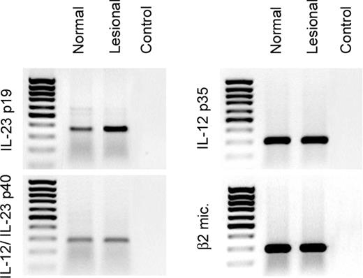 FIGURE 1. Keratinocytes express mRNA for the p19 and p40 subunits of the IL-23 heterodimer. Total RNA was isolated and reverse transcribed, and after 45 cycles of amplification, the products were analyzed. The mRNA integrity was controlled by amplification of β2-microglobulin. Both normal and lesional psoriatic keratinocytes were found to express mRNA for the IL-23-specific p19 subunit, in addition to the known expression of the IL-12 p35 and IL-12/IL-23 p40 subunits. This result is representative of keratinocytes from four normal individuals and four lesional psoriasis patients.