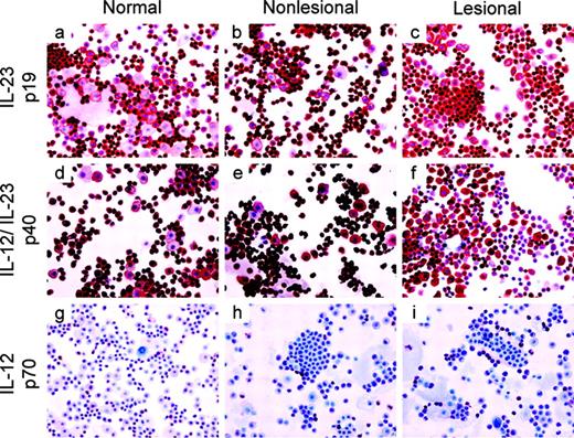 FIGURE 5. Cultured keratinocytes from normal, nonlesional, and lesional skin express IL-23 protein. Keratinocytes cultured on an object glass were stained by Abs specific for IL-23 p19, IL-12/IL-23 p40, or the IL-12 p70 heterodimer. IL-23 p19 expression in normal (a), nonlesional (b), and lesional (c) keratinocytes is presented. IL-12/IL-23 p40 expression in normal (d), nonlesional (e), and lesional (f) keratinocytes is shown. IL-12 p70 expression in normal (g), nonlesional (h), and lesional (i) keratinocytes is also presented. A clear expression of IL-23 p19 and IL-12/IL-23 p40 was present in all keratinocytes, whereas IL-12 p70 was expressed by a few cells. Data are representative of three different normal controls and three psoriasis patients (original magnification, ×200).