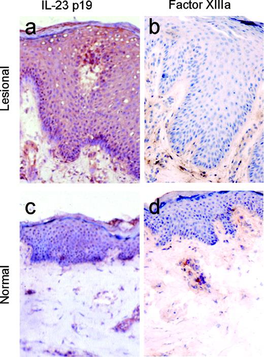 FIGURE 6. Expression of IL-23 p19 in normal and lesional psoriatic skin in situ. Immunohistochemical staining of skin sections with polyclonal rabbit anti-IL-23 p19 showed a diffuse positive staining pattern in the epidermis. The epidermis in lesional psoriatic skin (a) stained markedly stronger than the epidermis in normal skin (c) and the number of the positive dermal cells were higher in psoriatic than in normal dermal skin. Staining of psoriatic (b) and normal (d) skin sections with polyclonal rabbit anti-human Factor XIIIa Ab (detecting dermal DC) was performed as a control for the p19 staining (original magnification, ×200).