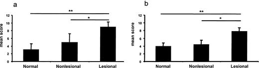 FIGURE 7. Significantly stronger expression of IL-23 in psoriasis lesional skin. Normal human (n = 7) and lesional psoriatic (n = 10) and nonlesional skin (n = 5) sections were stained for IL-23 p19 and the specific staining was scored in epidermis (a) and dermis (b). Significant difference (∗, p < 0.05; ∗∗, p = 0.001) shown.