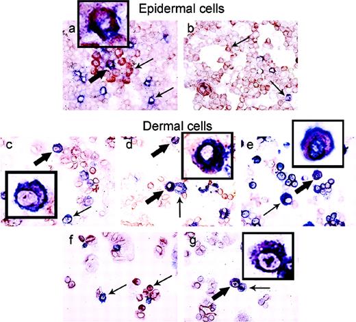 FIGURE 8. Identification of the IL-23 p19-expressing cells. Cytospin preparations of fresh epidermal and dermal cell suspensions were stained for IL-23 p19 (red) and several different cell markers (blue). The staining of the epidermal cells revealed that beside keratinocytes, the major group of epidermal cells expressing IL-23 p19, CD1a+ Langerhans cells expressed this subunit as well (a). HMB45+ melanocytes did not show costaining with the IL-23 p19 subunit (b). Most IL-23 p19 subunit expression in the dermis was present in DC and macrophages as identified by the expression of surface markers CD1c (c), CD36 (d) and HLA-DR (e). Approximately one-fifth of CD3+ T cells (f) expressed IL-23 p19 as well. The few CD83+ DC (g) in cytospin preparations of dermal cells were mostly IL-23 p19 positive. Thick arrows indicate double-positive cells and thin arrows single-positive cells (original magnification, ×400). Double-positive cells (inset) are shown.