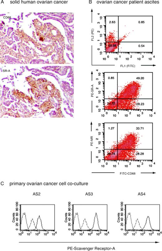 FIGURE 6. Expression of scavenger and MR on macrophages in human patient biopsies and malignant ovarian cancer ascites. A, Colocalization of CD68 and SR-A on macrophages in solid ovarian cancer (n = 10 patients). B, Unstained ovarian ascites (top panel), double staining of CD68/SR-A (middle panel), and double staining of CD68/MR (bottom panel). Numbers in quadrants represent percentage of positive cells (n = 10 patients). C, SR-A expression on unstained macrophages (dashed line), control macrophages (dashed and dotted lines), and cocultured macrophages (solid line). Primary human ovarian cancer cells (AS2, AS3, and AS4) were cocultured with human macrophages for 72 h.