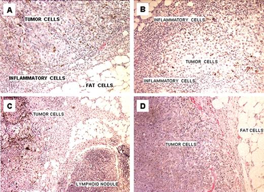 FIGURE 5. Histology of treated B16 melanoma lesions. A–C, Tumors were resected and sectioned on day 4 (A), day 14 (B), and day 16 (C) after the injection of α-gal glycolipids. D, A tumor injected with PBS and resected on day 10. The inflammatory response was already observed in α-gal glycolipid-treated tumors on day 4 and is much more extensive on day 14. A tumor resected on day 16 displayed a lymphoid nodule near the tumor cells. Representative sections of five tumors with similar results (H & E staining; original magnification, ×100) are shown.