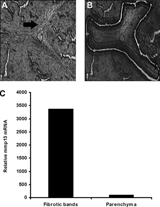 FIGURE 2. Relative mmp13 transcript level in fibrotic bands and parenchyma. A and B, Fibrotic bands were separated from nonscarred liver parenchyma in tissue sections by LCM in CCl4-treated rat liver at day 14 of recovery. C, mmp13 transcript level (relative to 18S rRNA) was 34-fold higher in the dissected fibrotic bands relative to parenchymal tissue in the recovering rat liver.