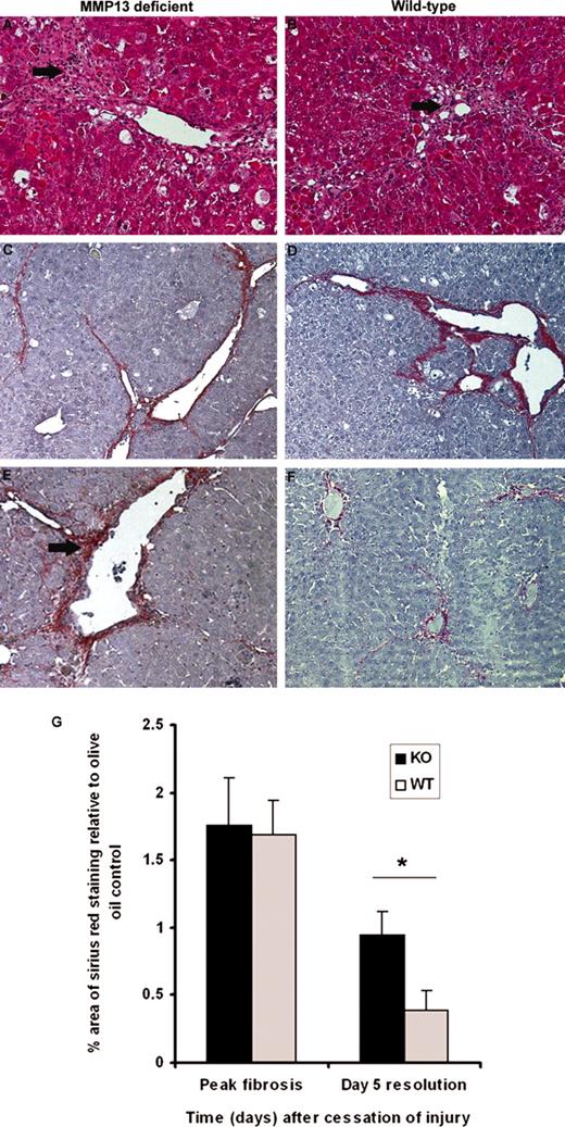 FIGURE 5. Remodeling of septal and perisinusoidal fibrosis is retarded in mice deficient in MMP13. A and B, CCl4-induced hepatic injury in mmp13−/− and WT mice. Analysis of H&E-stained sections at peak fibrosis revealed comparable necroinflammatory injury in mmp13−/− (A) and WT (B) animals. Typical changes associated with CCl4 damage were seen comprising fatty metamorphosis, zone III (centrilobular) necrosis, and a prominent inflammatory infiltrate (arrow) which included neutrophils and macrophages. C–G, Collagen staining by picrosirius red at peak fibrosis demonstrated significant pericentral collagen deposition with bridging fibrotic bands in both mmp13−/− (C) and WT (D) mice. E and F, After 5 days of spontaneous resolution, considerable matrix remodeling had occurred in the WT livers (F), but this process was attenuated in mmp13−/− mice (E) with persistence of septal collagen bands and perisinusoidal fibrosis (arrow). G, Morphometric quantitation of picrosirius red staining revealed a similar degree of collagen deposition in mmp13−/− and WT mice at peak injury, but by day 5 there was a clear difference with attenuated collagen degradation in the livers of mmp13−/− mice compared with WT counterparts (p < 0.05). Original magnifications, ×100. KO, Knockout.