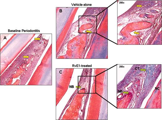 FIGURE 6. Regeneration of bone and connective tissues. New bone and connective tissue formation was evaluated by Masson’s trichrome staining. Periodontal disease resulted in soft tissue degradation (loss of interdental papillae) and bone loss as indicated by yellow arrows (×100, A). In sections treated with vehicle-alone (B), the progression of periodontal inflammation characterized by further collagen destruction and bone loss was observed (depicted by yellow arrows in higher magnification, ×200; B, inset). Conversely, reformation of soft tissue (interdental papillae) and bone regeneration were noted in sections treated with RvE1 (green arrow; ×100, C). In higher magnification (×200), new collagen deposition (in blue) and new bone and cementum formation (in red) were also detected (C, inset). The newly formed alveolar bone presented large bone marrow spaces in the central area of the defect, whereas mineralized bone was seen in the periphery (×200, C, inset) (CT, connective tissue; NB, new bone; NC, new cementum).