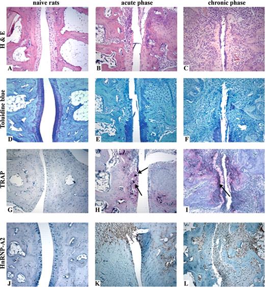 FIGURE 7. Histological and immunohistochemical analysis of PIA. Tissue sections prepared from the hind paws of naive DA.1F rats and rats during the acute and chronic phases of PIA were analyzed by H&E staining, toluidine blue staining, TRAP staining, and by immunohistochemistry using the mAb 10D1 specifically recognizing hnRNP-A2 and its major splice variants. A–C, H&E staining of tissue sections showing the invasion of synovial inflammatory tissue into subchondral space during acute and chronic phase of PIA. D–F, Toluidine blue staining showing extensive proteoglycan loss (visualized by washy blue color) and destruction of cartilage during the progression of PIA. G–I, TRAP staining revealing osteoclasts (purple color, black arrowheads) resorbing cortical bone during acute and chronic phase of PIA. J–L, Immunohistochemical analysis revealing massive overexpression of hnRNP-A2 (brown staining) during the acute and chronic phases of PIA in synoviocytes of the inflammatory pannus tissue, chondrocytes of articular cartilage, and osteoclast-like multinucleated cells (black arrowheads). Original magnification is 100-fold in all panels.