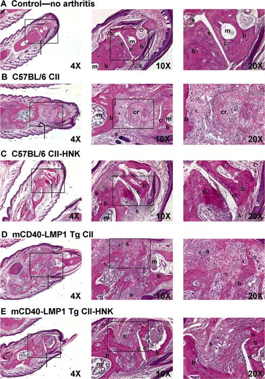FIGURE 4. Effect of HNK on CIA-mediated inflammation. H & E-stained tissue sections from the hind paws of a control mouse (representing naive or CFA only C57BL/6 and mCD40-LMP1 Tg mice) (A), a C57BL/6 mouse immunized with CII/CFA (B), a C57BL/6 mouse immunized with CII/CFA and treated with HNK (C), a mCD40-LMP1 Tg mouse immunized with CII/CFA (D), and a mCD40-LMP1 Tg mouse immunized with CII/CFA and treated with HNK (E). Paws were analyzed on day 70 postimmunization. Each section was presented at ×4, ×10, and ×20 original magnification, with the magnified field boxed. For orientation: b, bone; c, cartilage; s, synovium; m, marrow; cr, cartilage remodeling; ∗, representative site of inflammation.