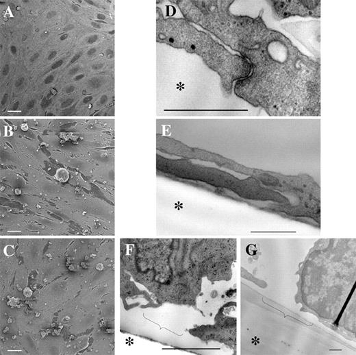 FIGURE 3. Ultrastructural analysis of hCMEC/D3 cells cocultured with lymphocytes for 6 h. A–C, Scanning electron microscopy of hCMEC/D3 monolayers cultured with CEM (A) or HTLV-1-infected HUT-102 (B), or C81-66 (C) cells. White bar represents 10 μm. D–G, Transmission electron microscopy showing electron-dense TJs in hCMEC/D3 cells cocultured with CEM cells for 6 h (D) or absence of TJs in hCMEC/D3 cells cocultured with HUT-102 (E). Disruption of hCMEC/D3 monolayer after 6 h of coculture with C81-66 (F) or PBMCs from patient A (G). Bar represents 500 nm. Asterisk (∗) indicates the filter location of the Transwell device. Brackets indicate the local cell retraction observed.