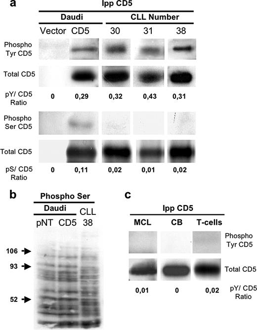 FIGURE 1. CD5 is naturally phosphorylated on tyrosine in CLL B cells. a, A total of 10 × 106 vector- and CD5-transfected Daudi cells and 15 × 106 CLL cells were lysed and immunoprecipitated (Ipp) with anti-CD5 mAb and analyzed by Western blotting using anti-phosphotyrosine, anti-phosphoserine, or anti-CD5 Abs. The ratios of tyrosine-phosphorylated over total CD5 (pY/CD5 ratio) and serine-phosphorylated over total CD5 (pS/CD5 ratio) were calculated by densitometry scanning. b, Analysis of serine phosphorylation in total lysates from CLL and Daudi cell samples blotted with anti-phosphoserine Ab, molecular weights (arrows). c, Mantle cell lymphoma (MCL) cord blood B cells (CB) and purified adult T cells (T) all expressing CD5, were analyzed for CD5 phosphorylation on tyrosine as in a. Membranes were exposed for 1 h (anti p-serine) and otherwise for 5 min.