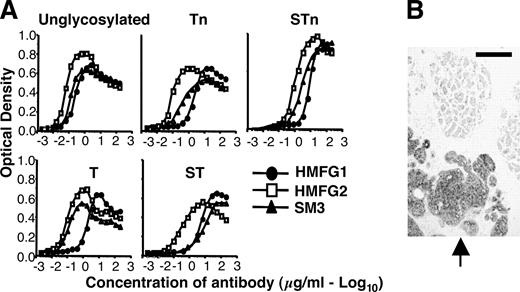 FIGURE 4. HMFG2 exhibits broad reactivity with tumor-associated glycoforms of MUC1. A, Binding of biotinylated MUC1 Ab (HMFG1, HMFG2, and SM3) to immobilized MUC1 glycoforms was detected using a colorimetric assay following incubation with peroxidase-conjugated streptavidin. Similar results were obtained in three separate experiments (Table II and data not shown). B, Representative tissue section demonstrating HMFG2 staining of normal breast tissue (top) immediately above primary grade III infiltrating ductal carcinoma (arrow). Scale bar, 50 μm.
