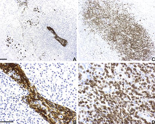 FIGURE 6. Graft rejection seen in formalin-fixed sections taken from the autopsy of an atypical subject, DIG101, who had been given low potency suppression. The tissue was reacted with CK (A and B) and CD3 (C and D). A and C are shown at ×10 original magnification; the bar in A is 100 μm. B and D are shown at ×40 original magnification; the bar in B is 50 μm.