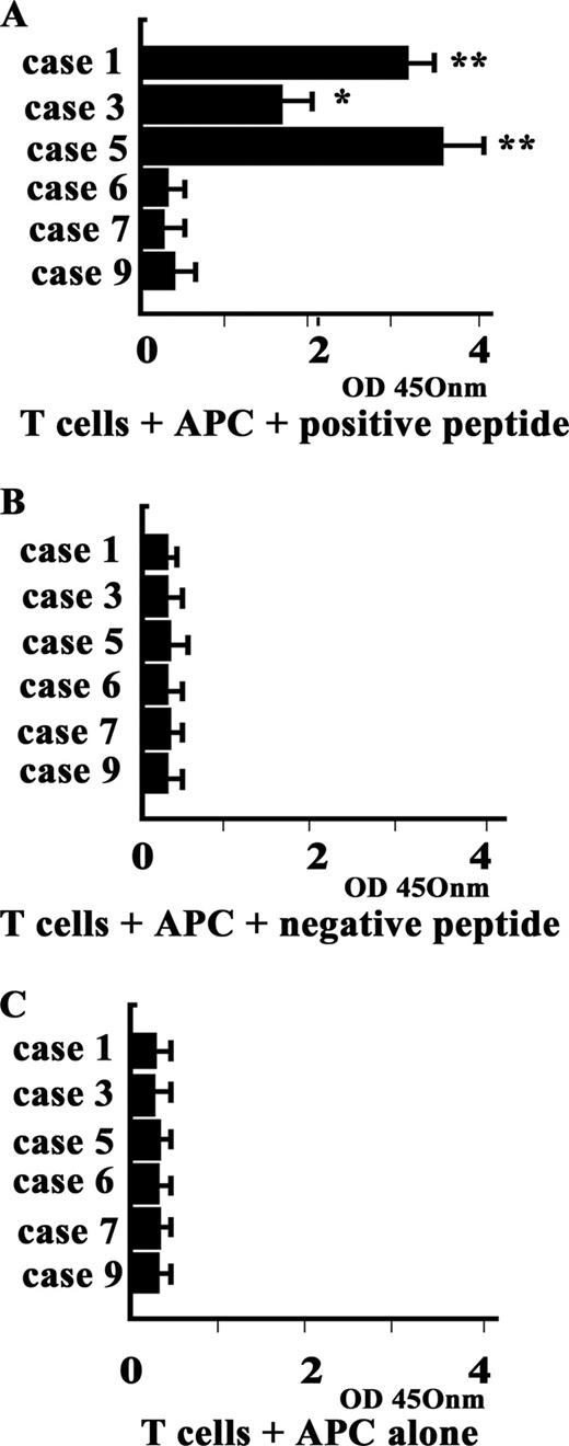 FIGURE 3. BrdU assay response of CD4-positive T cells to N-terminal peptides of annexin 1 in patients with acute exacerbation of IPF cases. Values represent means + SD of triplicate cultures. A, T cells + APC + positive peptide (QEYVQTVKS). Annexin 1-positive peptide induced marked proliferative responses of CD4-positive T cells with APC (alveolar macrophages) in three patients (cases 1, 3, and 5) with high titers of anti-annexin 1 Abs compared with another three patients (cases 6, 7, and 9). Asterisks indicate values significantly different from other cases or peptides (∗, p < 0.05; ∗∗, p < 0.01). B, T cells + APC + negative peptide. C, T cells + APC alone. Annexin 1-negative peptide (DARALYEAG) or no peptide induced proliferative responses of CD4-positive T cells in none of all six patients.
