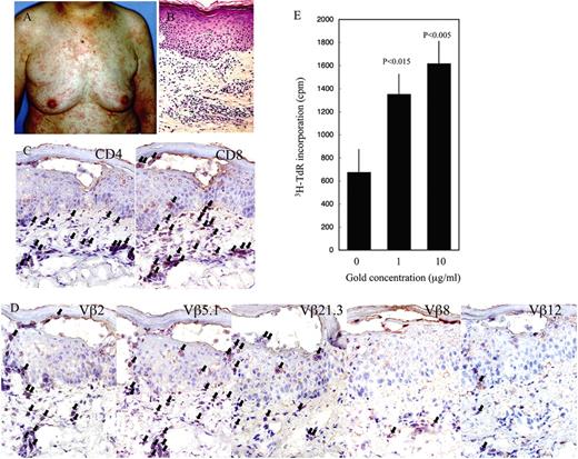 FIGURE 1. Clinical and laboratory findings of a RA patient with skin rashes. A, Maculopapular rashes. B, Pathology of a biopsied skin lesion. H&E staining. C, Immunohistochemical staining. Arrows, positively stained cells. D, Immunohistochemical staining of the skin lesion with anti-Vβ mAbs. Arrows, positively stained cells. E, PBMCs from the patient exhibit significant proliferation in response to gold. Vertical bars, SD.