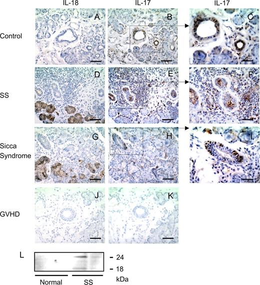 FIGURE 1. Detection of IL-18 and IL-17 in the salivary glands of SS patients. A–K, Sequential cryosections of labial salivary glands of control subjects (A–C), patients with SS (D–F), patients with sicca syndrome (G–I), and patients with chronic GVHD (J and K) were stained with anti-IL-18 mAb 25-2G (A, D, G, and J) or rabbit anti-human IL-17 polyclonal Ab (B, C, E, F, H, I, and K) (brown). The sections were counterstained with hematoxylin (blue). The same results were obtained with goat anti-human IL-17 polyclonal Ab. High magnification of areas (square) in B, E, and H was shown as C, F, and I, respectively. Scale bar represents 100 μm (A, B, D, E, G, H, J, and K) and 50 μm (C, F, and I). L, Lysates of the labial salivary glands of control subjects (n = 2) and patients with SS (n = 2) were subjected to Western blotting with anti-IL-18 mAb 25-2G.