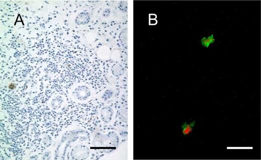 FIGURE 2. Detection of IL-18-expressed CD68+ macrophages in the salivary glands of SS patients. Cryosections of labial salivary glands of SS patients were stained with anti-CD68 mAb PG-M1 (brown) (A) or double stained with anti-CD68 mAb PG-M1 (red) and anti-IL-18 mAb 25-2G (green) (B). Scale bar represents 100 μm (A) and 10 μm (B).