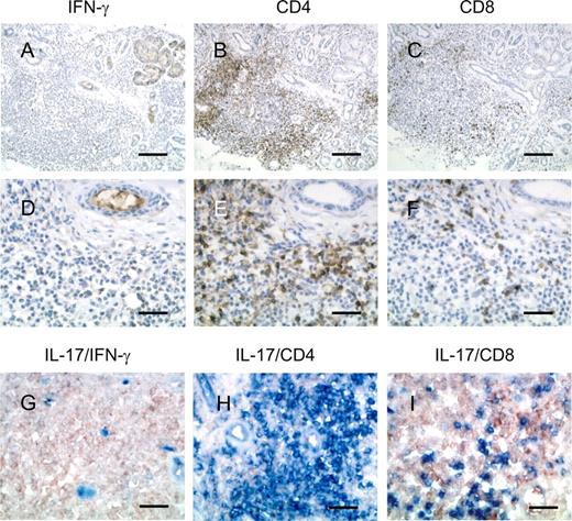 FIGURE 3. Detection of IL-17 in infiltrating CD4+ and CD8+ T cells in the salivary glands of SS patients. Sequential cryosections of labial salivary glands of SS patients were stained with anti-IFN-γ (A and D), anti-CD4 mAb SK3 (B and E), and anti-CD8 mAb SK1 (C and F) (brown). The sections were counterstained with hematoxylin in blue. The same sections were double stained with rabbit anti-human IL-17 polyclonal Ab (light brown) and with anti-IFN-γ (G), anti-CD4 mAb SK3 (H), and anti-CD8 mAb SK1 (I) (light blue). Dark blue indicates double positive cells. Scale bar represents 200 μm (A–C) and 50 μm (D–I).