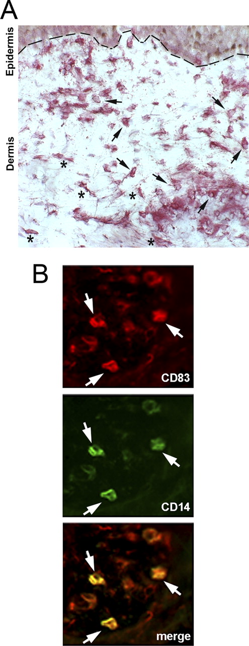 FIGURE 7. Detection of IFN-α proteins and CD83+CD14+ cells in varicella skin lesions. A, Representative cryostat serial sections of varicella skin lesions were stained with anti-IFN-α (MMHA-2) according to the APAAP (alkaline phosphatase anti- alkaline phosphatase) technique. Positive cells with a plasmacytoid, round shape morphology are indicated by arrows, while asterisks indicate the fibroblast- and macrophage-like ones (original magnification ×200). B, Sections of varicella skin lesions were double stained with anti CD83-PE and CD14-FITC and analyzed by fluorescence microscopy (original magnification ×400).