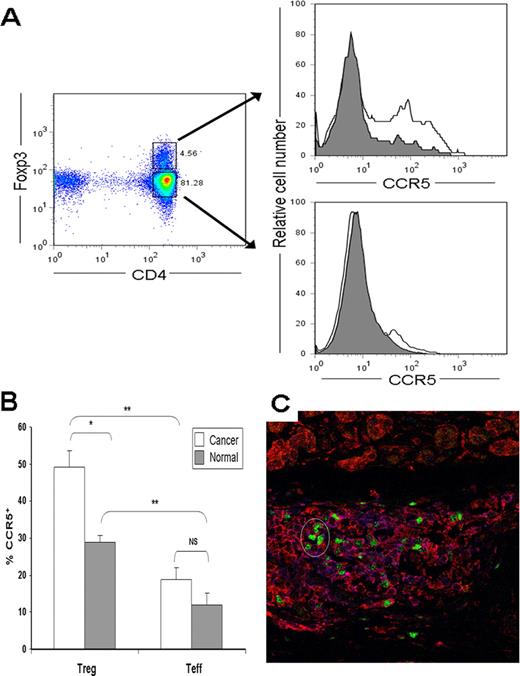 FIGURE 1. Increased expression of CCR5 by CD4+Foxp3+ Tregs from patients with pancreatic adenocarcinoma. A, PBMCs from patients with pancreatic adenocarcinoma (cancer, n = 9, white histogram) and healthy volunteers (normal, n = 9, gray histogram) were isolated as described in Materials and Methods and then stained for CD4, CCR5, and Foxp3. Representative plots of CCR5 expression for CD4+Foxp3+ (top right) and CD4+Foxp3− (bottom right). B, Bar graph, percent of CD4+Foxp3+ cells (Treg) and CD4+Foxp3− cells (Teff) staining positive for CCR5. Results represent mean ± SEM. ∗, p < 0.005; ∗∗, p < 0.001; NS, nonsignificant. C, Tregs in the tumor microenvironment express CCR5. Representative image from sections of surgically resected, formalin-fixed, human pancreatic adenocarcinoma (n = 6 patients) costained for Foxp3 (green) and CCR5 (red).