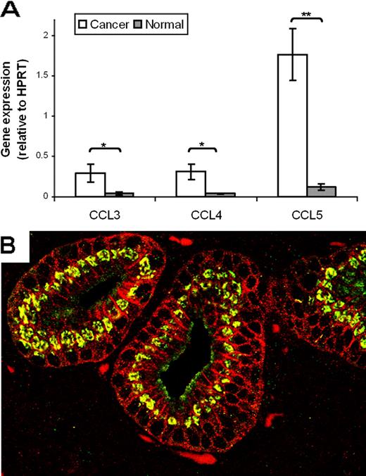 FIGURE 2. Production of CCR5 ligands is increased in human pancreatic adenocarcinoma. A, RNA was extracted from fresh frozen specimens of histologically verified pancreatic adenocarcinoma (n = 13) and normal pancreas (n = 4), and RT-PCR was performed. Gene expression (mean ± SEM, relative to hypoxanthine-guanine phosphoribosyltransferase; HPRT) of CCL3, CCL4, and CCL5 in malignant tissue was elevated 7-, 9-, and 15-fold compared with normal pancreas. ∗, p < 0.05; ∗∗, p < 0.001. B, Representative image from sections of surgically resected human pancreatic adenocarcinoma costained for the CCR5 ligand, CCL5 (green), and the tumor cell surface marker, EpCAM (red). Areas of colocalization appear yellow. Of the 17 cases examined, in 8 specimens there was colocalization of EpCAM and CCL5, indicating that tumor cells were producing CCL5.