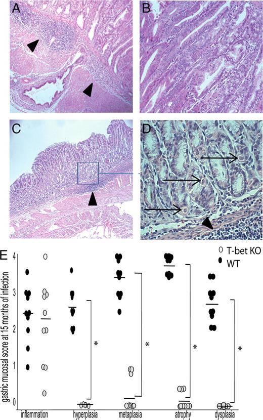 FIGURE 5. Infected WT mice develop gastrointestinal intraepithelial neoplasia (GIN) at 15 mo. T-bet KO mice are protected. WT and T-bet KO mice were infected with H. felis for 15 mo. A, WT mice have persistent inflammation, glandular distortion with marked corpus metaplasia, parietal cell and chief cell loss, and GIN (×4). Gastric glands are seen herniating into the underlying tissue (arrow heads). B, Severe gland distortion with branching, piling up of cells, marked cellular and nuclear atypia with nuclear stratification, and altered nuclear-to-cytoplasmic ratio (×40). C, T-bet KO mice have persistent inflammation (arrowheads) with sparing of parietal (arrows) and chief cell populations (×4); better seen in D (×60) of the boxed area in C. E, Gastric injury scores are shown below the histology images. *, p < 0.02.