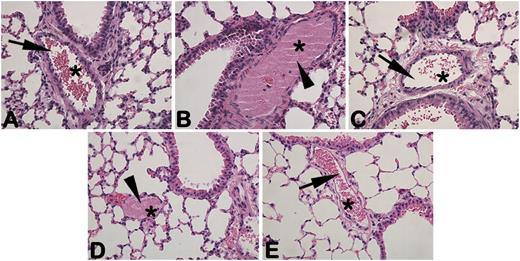 FIGURE 3. IC-induced thrombosis occurred only in mice transgenic for the human FcγRIIA gene. H&E-stained lung sections from WT mice (A) and FCGR2A mice (B) injected with preformed M90 IC (138 μg M90 and 50 μg hCD40L). C, FCGR2A mice injected with 138 μg irrelevant IgG control 9E10 anti–c-myc and hCD40L 50 μg. D, FCGR2A mice injected with preformed IC138 μg hMR1 and 50 μg mCD40L. E, FCGR2A mice injected with 138 μg Agly-hMR1 and 50 μg mCD40L. Arrow identifies normal vasculature supporting alveoli. Arrowhead identifies occluded vessel. Asterisks (*) identify blood vessels adjacent to pulmonary bronchiole. Images were captured at ×400 magnification.