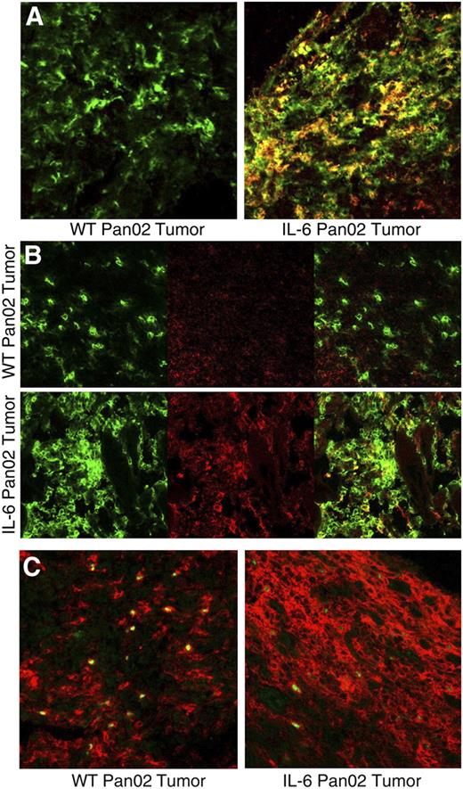 FIGURE 5. Immunohistochemical analysis of CD4+ lymphocytic infiltrate from IL-6 Pan02 or WT Pan02 tumor sections for Th17 cells and Tregs. A, Cell-surface staining of IL-23R suggested that IL-6 Pan02 tumors demonstrated more CD4+IL-23R+ cells, indicative of Th17 cells, in the lymphocytic infiltrate compared with the WT Pan02 tumors. Green: CD4+; red: IL-23R+; yellow: CD4+IL-23R+. B, Intracellular staining of IL-17 cytokine suggested that IL-6 Pan02 tumors again demonstrated more CD4+IL-17+ cells, indicative of Th17 cells, in the lymphocytic infiltrate compared with the WT Pan02 tumors. Green: CD4+; red: IL-17+; yellow: CD4+IL-17+. C, Intracellular staining of Foxp3 transcription factor in the WT and IL-6 Pan02 tumors. Red: CD4+; green: Foxp3+. More CD4+ lymphocytes were noted in the IL-6 Pan02 tumor sections compared with WT Pan02 tumors. See Materials and Methods for immunohistochemical staining. Confocal images were taken at ×400 magnification.