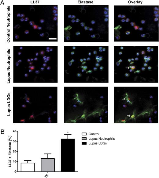 FIGURE 3. LL-37 externalization in NETs is increased in lupus LDGs. A, Representative images of control neutrophils, lupus neutrophils, and lupus LDGs after isolation from peripheral blood. Cells were stained for detection of LL-37 (red) and neutrophil elastase (green), and DNA was labeled with Hoechst 33342 (blue). Top panels show images of LL-37 and Hoechst (left panels), elastase and Hoechst (middle panels), and merged LL-37, elastase, and Hoechst (right panels). Original magnification ×40. Scale bar, 20 μm. Arrows represent areas of LL-37 localization within the NETs. B, Quantification of the percentage of cells containing LL-37 colocalized with elastase over total number of cells are plotted as mean ± SEM (n ≥ 3 patients). *p ≤ 0.05.