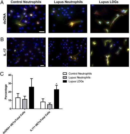 FIGURE 4. Lupus LDGs externalize dsDNA and IL-17 through NETosis. Representative images of control neutrophils, lupus neutrophils, and lupus LDGs after isolation from peripheral blood. Cells were stained for detection of neutrophil elastase (green), DNA (Hoechst 33342, blue), and either dsDNA (red) or IL-17 (red). Merged images of dsDNA, elastase, and Hoechst (A) and merged images of IL-17, elastase, and Hoechst (B). C, Quantification of the percentage of cells containing dsDNA or IL-17 colocalized with elastase over total number of cells is plotted as mean ± SEM (n ≥ 5 patients). Scale bars, 20 μm. *p ≤ 0.05.